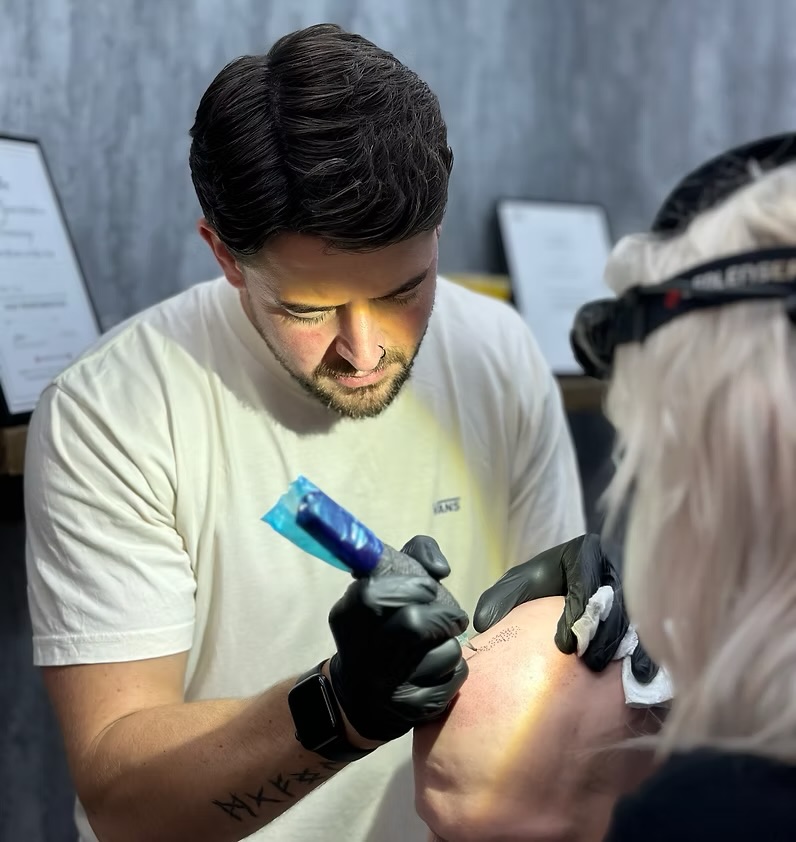 Apex SMP practitioner performing a scalp micropigmentation treatment